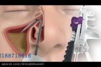 جراحی آندوسکوپی سینوس و کاربرد آن