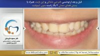 درمان اپن بایت با ارتودنسی | دکتر داوودیان