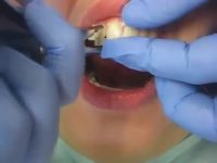 درآوردن براکت های ارتودنسی (دیباند) | دکتر مسعود داودیان