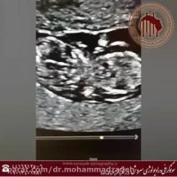 فیلم سونوگرافی جنین غیر نرمال