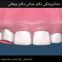 جراحی افزایش طول دندان