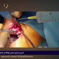 خارج سازی دندان نهفته