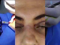 بلفاروپلاستی