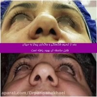 فیلم درمان شکستگی وسیع کف حدقه چشم (اربیت)