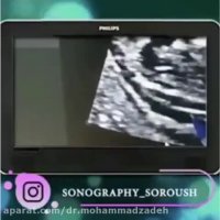 فیلم سونوگرافی NT جنین