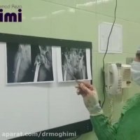 شکستگی خرد شده ناحیه تروکانتریک با پروتز گذاری یا آرتروپلاستی در فرد مسن