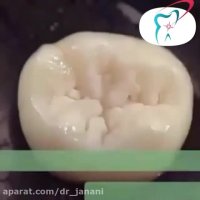 فیشور سیلانت یا شیار پوش