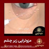 روش مزوتراپی زیر چشم