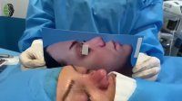 جراحی ترمیمی بینی با کوتاهی بسیار زیاد | دکتر باستانی نژاد