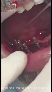 نصب همزمان ۸ ایمپلنت