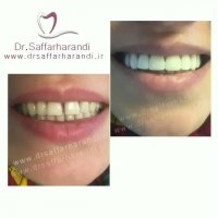 بستن فاصله ی بین دندان ها و اصلاح طرح لبخند.