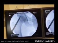 سیاه شدن سر استخوان ران (پارت 1)