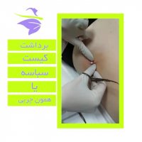 برداشت کیست سبابه یا همان چربی توسط دکتر حبیبی زاده