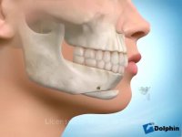 جراحی جلو آوردن چانه | دکتر مسعود داوودیان