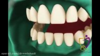 فیلم بلیچینگ دندان