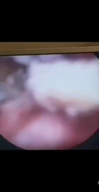 فیلم جراحی بزرگی خوش خیم پروستات BPH