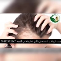 آیا ریزش مو شوید دارید ؟؟علت اصلی چیست ؟؟؟