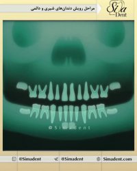 مراحل رویش دندان های شیری و دائمی | دندانپزشکی سیمادنت