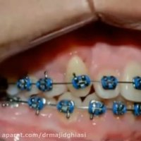 ارتودنسی دندان زیبایی