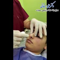 فیلم جراحی بینی بسته