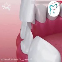 درمان زیبایی لمینت دندان
