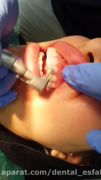 کامپوزیت ونیر دندان در اصفهان - دندانپزشکی زیبایی چاوش در اصفهان