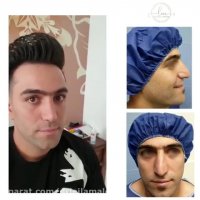 رضایت مراجعه کننده جراحی بینی پس از یک سال