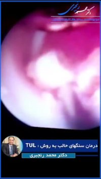 انیمیشن جالب از درمان سنگ کلیه