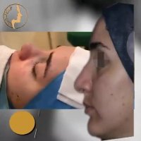 بلافاصله پس از عمل بینی | دکتر گلی