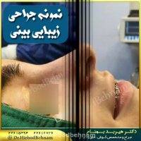 فیلم عمل بینی استخوانی توسط دکتر هیربد بهنام