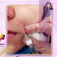 فیلم تزریق ژل خط خنده