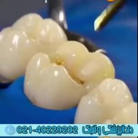 نحوه ترمیم و پر کردن دندان
