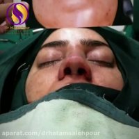 جراحی بینی گوشتی
