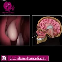 جراحی پولیپ بینی