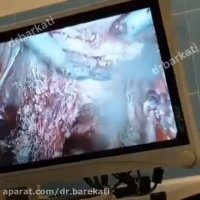 جراحی لاپاراسکوپی رحم و تخمدان