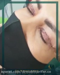 فیلم جراحی بلفاروپلاستی جهت رفع افتادگی پلک با بی حسی موضعی در مطب