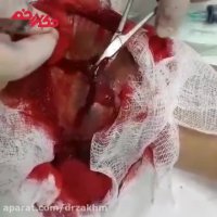 جراحی زخم پای دیابتی توسط تیم فوق تخصصی دکتر زخم (پارت3)