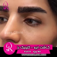 فیلم کاشت ابرو | کلینیک رز | 02148679 | شماره 1