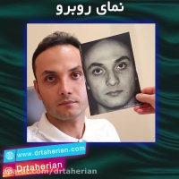 جراحی بینی بعد از 6 ماه