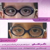 فیلم نمونه واقعی جراحی انحراف چشم در کودک 5 ساله