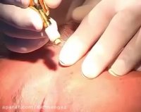 کرایوتراپی نیتروس اکساید