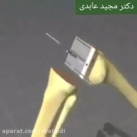 آرتروز زانو و ساییدگی مفصل زانو