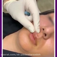 تزریق ژل لب