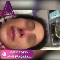 نتیجه عمل بینی بلافاصله بعد از برداشتن پانسمان