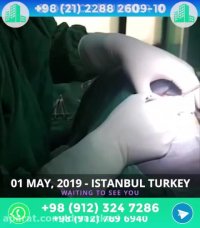 عمل پروتز چانه