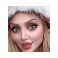 نمونه جراحی بینی با فیلر صورت بوتاکس و ژل لب