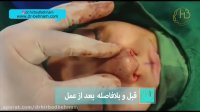 فیلم عمل جراحی بینی واقعی