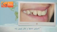 قبل و بعد ارتودنسی دندان نیش بیرون زده | دکتر مسعود داوودیان