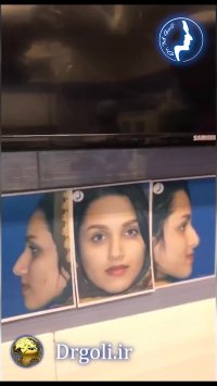 عمل زیبایی بینی با انحراف زیاد | دکتر محمد گلی