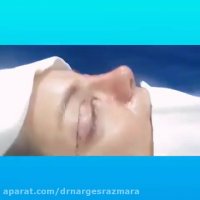 جراحی پلک بالا و جراحی بینی